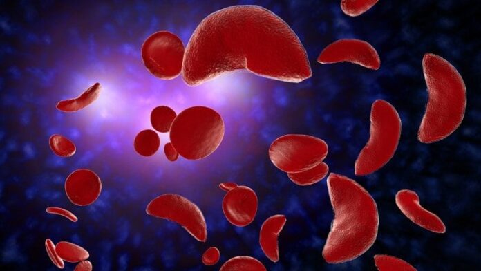 Infusion Centers May Best EDs for Treating Sickle Cell Crises
